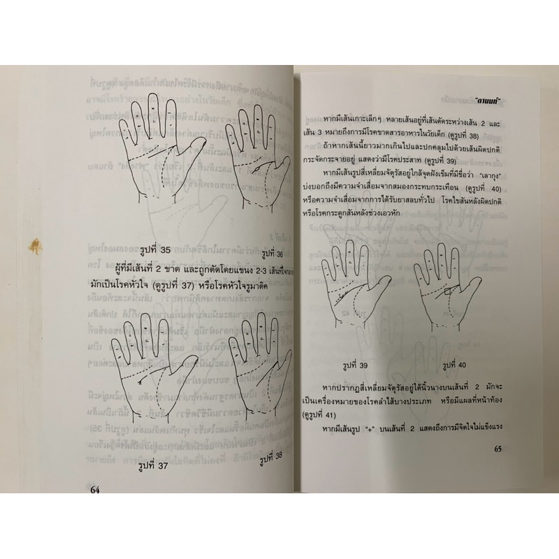 รู้โรคร้ายด้วยลายมือ โดย ดานนท์ หัตถศาสตร์การแพทย์ รูปที่ 8