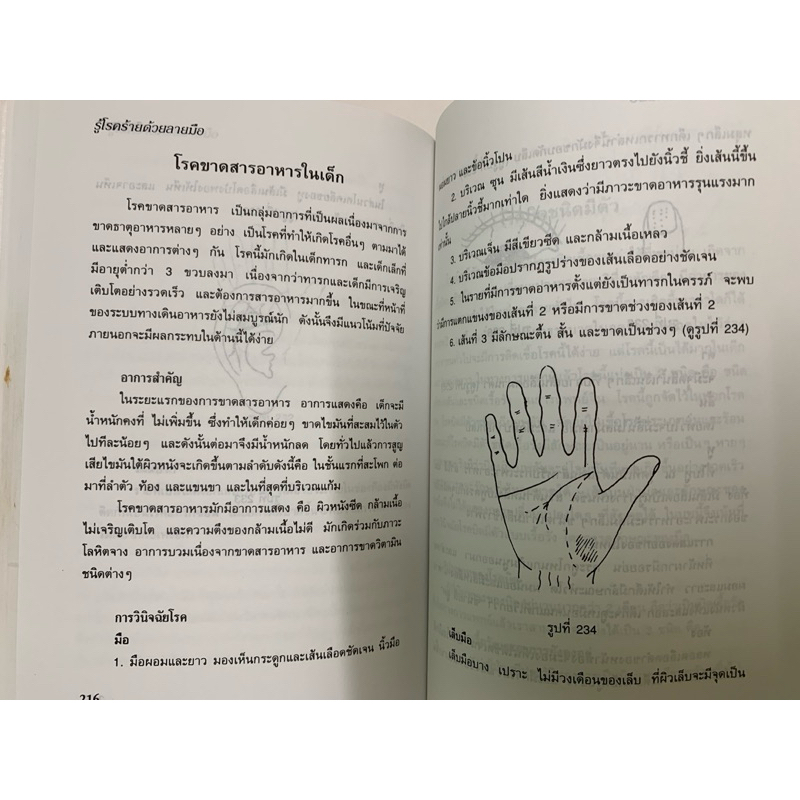 รู้โรคร้ายด้วยลายมือ โดย ดานนท์ หัตถศาสตร์การแพทย์ รูปที่ 9