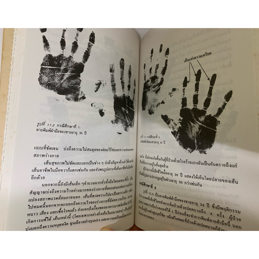 วิเคราะห์มือสื่อสุขภาพ ยูจีน ไชมันน์ *ลายมือ รูปที่ 9
